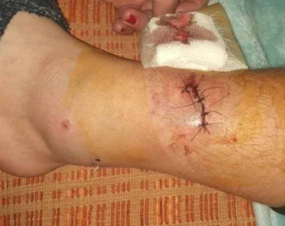 En el Médano, un niño de 11 años fue mordido por un pitbull y le dieron 15 puntos