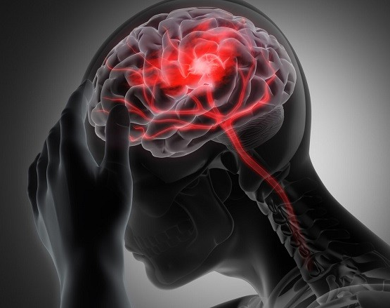 Salud informa los factores para reconocer a tiempo un ACV