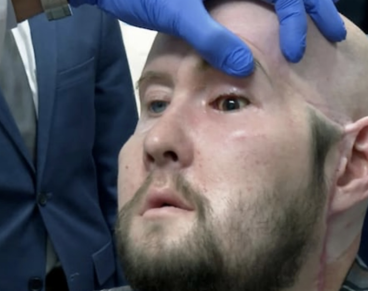 Un hombre recibe con éxito el primer trasplante de ojo completo en el mundo