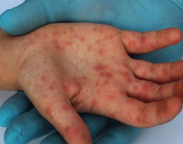 Alerta: Salud evalúa un segundo caso sospechoso de la Viruela del Mono