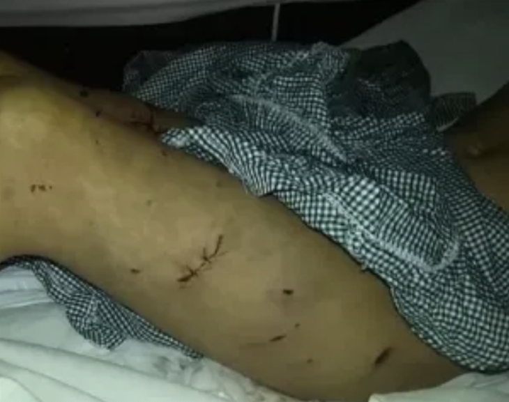 Un nene de 9 años fue atacado por una jauría en Mar del Plata