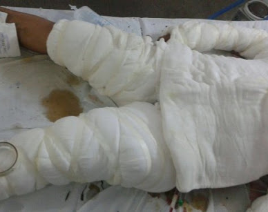 Una mujer sufrió quemaduras en el 30 % de su cuerpo: sospechan del marido 