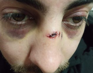 Patovicas sanjuaninos atacaron brutalmente a un joven y lo dejaron en grave estado