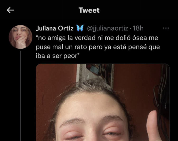 Viral: por una alergia se le deformó la cara y su amiga le hizo un meme