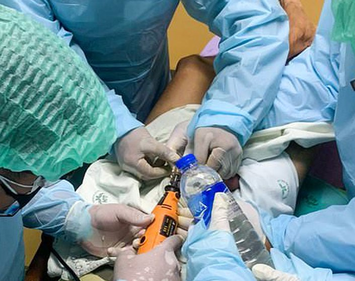 Un joven murió en India tras sellar sus genitales con un fuerte adhesivo para evitar que su novia se embarazara