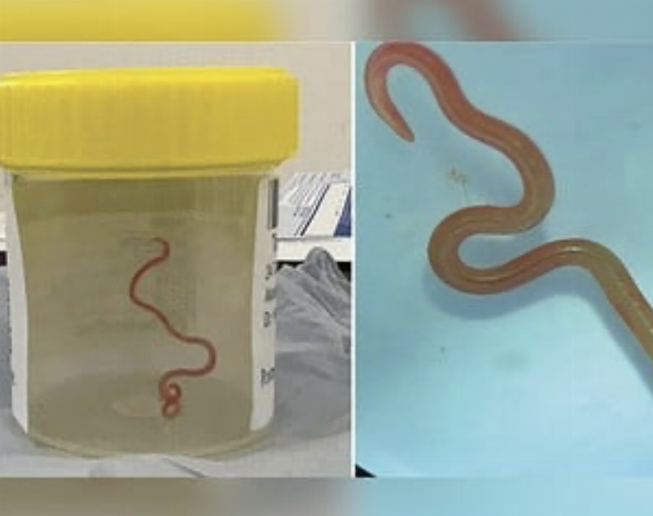 Extraen una lombriz parásita viva del cerebro de una mujer: medía 8 centímetros