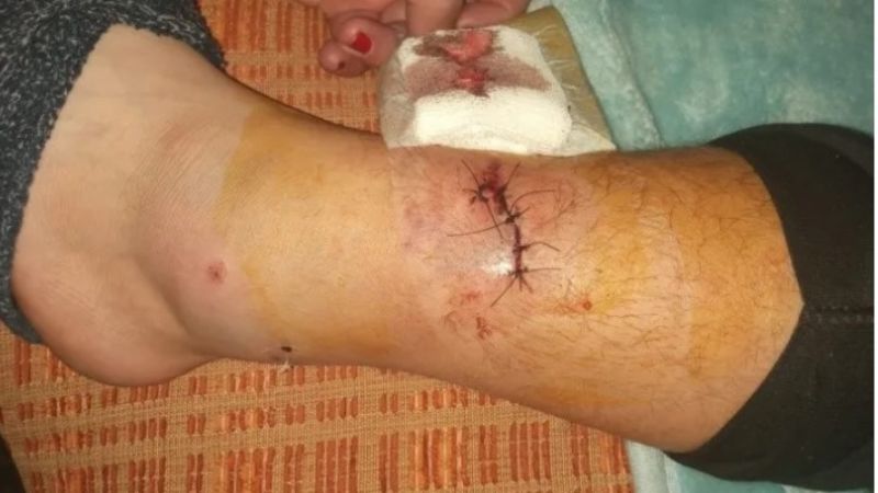 En el Médano, un niño de 11 años fue mordido por un pitbull y le dieron 15 puntos