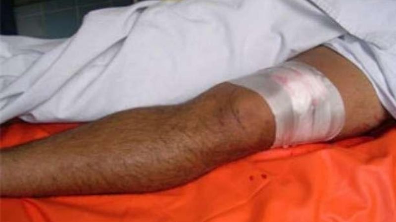 Se fractura la pierna producto de un balazo