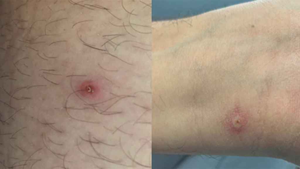La viruela del mono llegó a San Juan con el primer caso en un paciente
