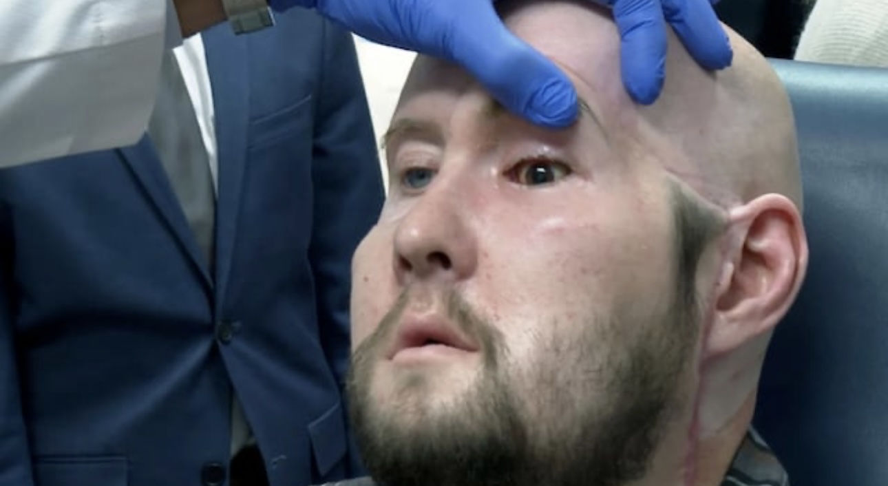 Un hombre recibe con éxito el primer trasplante de ojo completo en el mundo