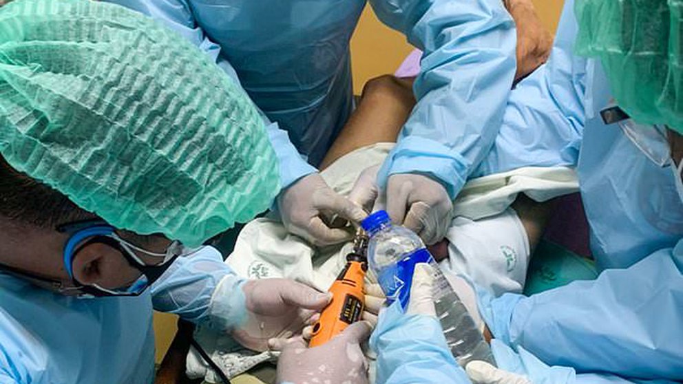 Un joven murió en India tras sellar sus genitales con un fuerte adhesivo para evitar que su novia se embarazara