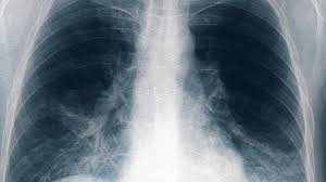 Tucumán: confirmaron una quinta muerte por neumonÃa causada por la bacteria Legionella