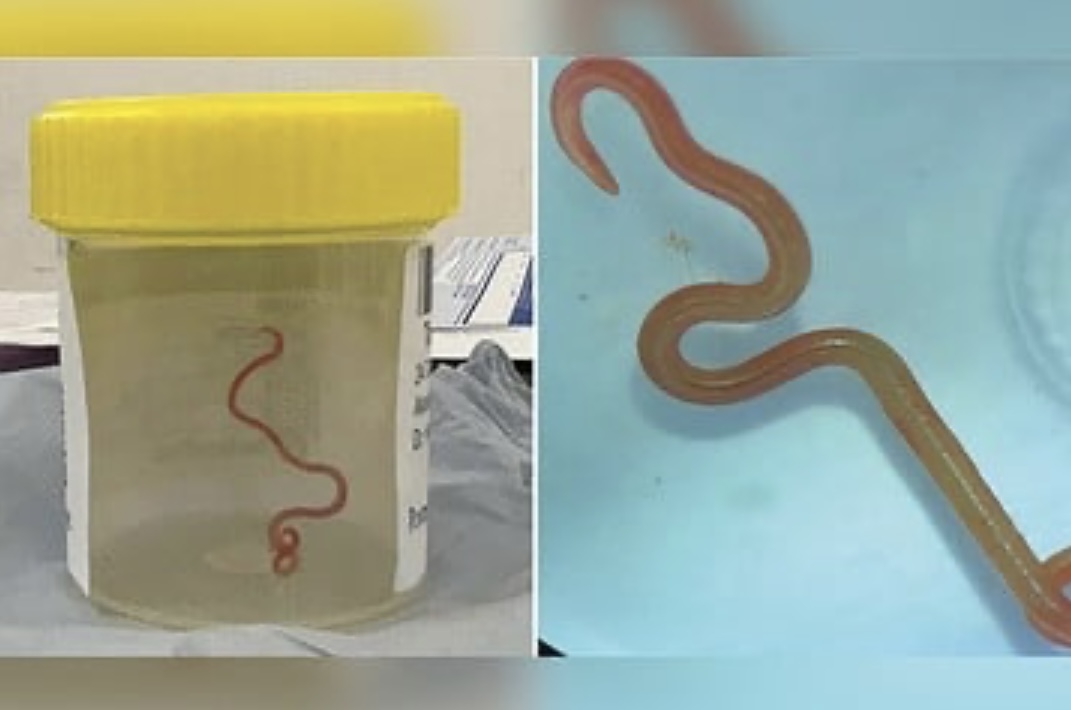 Extraen una lombriz parásita viva del cerebro de una mujer: medía 8 centímetros